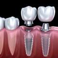 Dental Implants In Delhi NCR