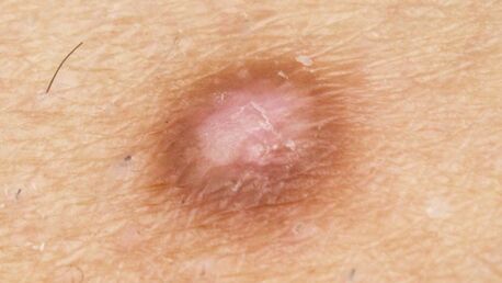 London, Health, Dermatofibroma Removal UK | Expert Dermatofibroma Surgery & Excision | Interface Clinic