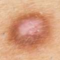 Dermatofibroma Removal UK | Expert Dermatofibroma Surgery & Excision | Interface Clinic