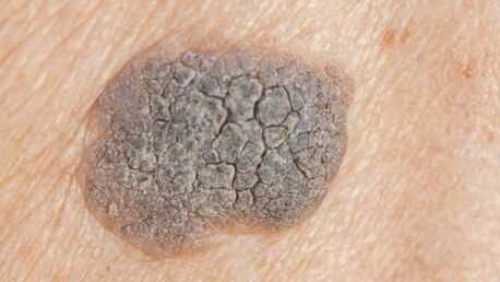 London, Health, Seborrhoeic Keratoses Removal | Safe & Effective Treatment | Interface Clinic