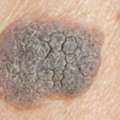 Seborrhoeic Keratoses Removal | Safe & Effective Treatment | Interface Clinic