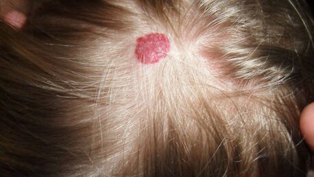 London, Health, Haemangioma Removal Clinic | Cherry Angioma Treatment | Interface Clinic