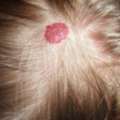 Haemangioma Removal Clinic | Cherry Angioma Treatment | Interface Clinic