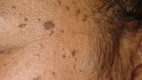London, Health, Dermatosis Papulosa Nigra Treatment & DPN Removal Clinic UK | Interface Clinic