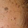 Dermatosis Papulosa Nigra Treatment & DPN Removal Clinic UK | Interface Clinic