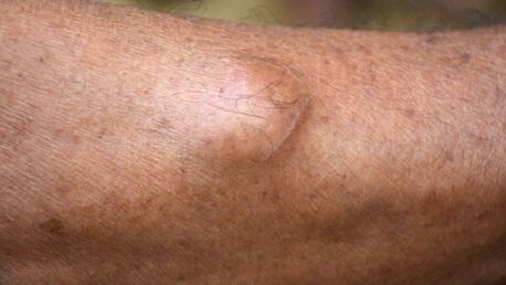 London, Health, Lipoma Removal In London | Lipoma Excision & Surgery | Interface Clinic