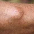Lipoma Removal In London | Lipoma Excision & Surgery | Interface Clinic