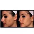 Exosome Hair Growth Treatment