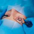 Best Standard LASIK Eye Surgery In India - Expert Eye Care