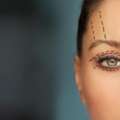 Eyelid Surgery In Mumbai &ndash; Expert Blepharoplasty Solutions