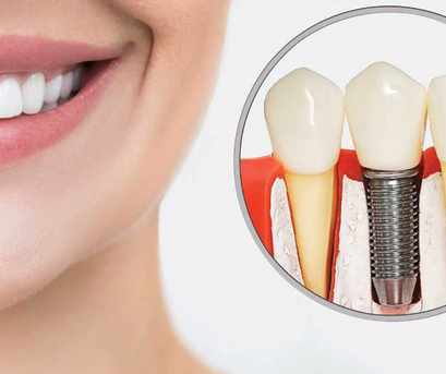 New York, Dental, Dental Implants Canton MA: Restore Your Smile With Lasting Results