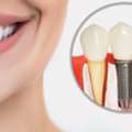 Dental Implants Canton MA: Restore Your Smile With Lasting Results