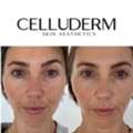 Laser Clinic Richmond: Personalised Laser Skin Treatments At CelluDerm