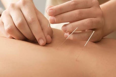 New York, Health, Pain Management Acupuncture In NYC | Back, Neck & Sciatica Relief