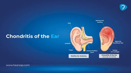 Hyderabad, Health & Beauty Items, INR 30,  Chondritis Ear: Symptoms, Causes & Treatment Guide