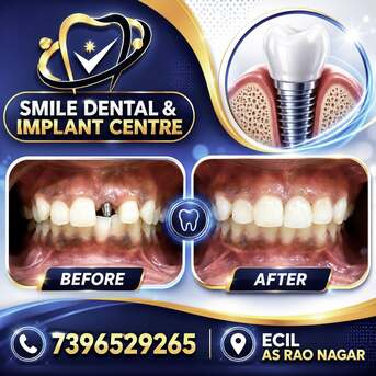 Hyderabad, Dental, Restore Your Smile Permanently: Dental Implants In AS Rao Nagar