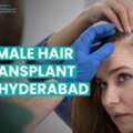 Female Hair Transplant In Hyderabad For Thinning Hair