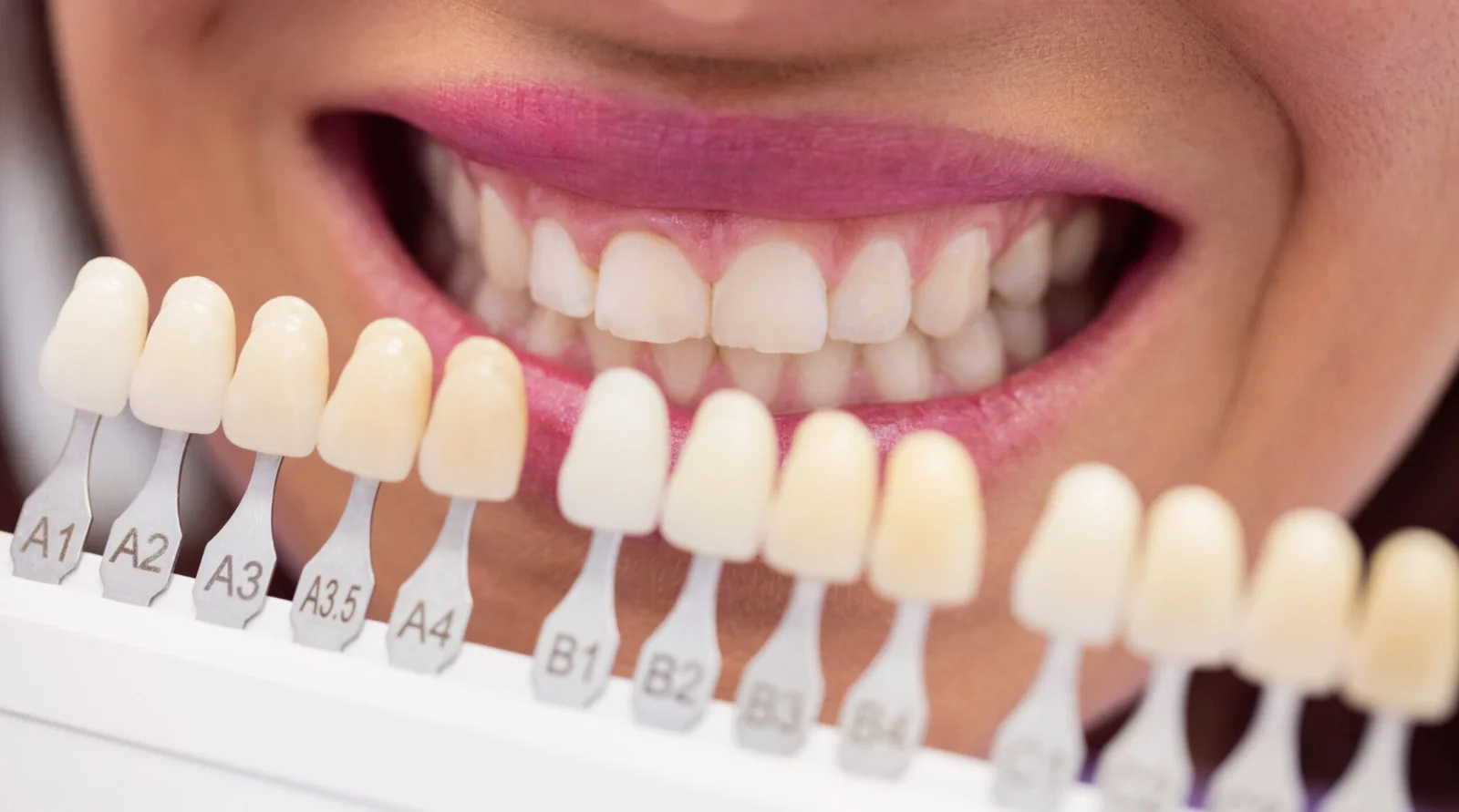 Hyderabad, Dental, Dental Veneers Treatment In Kondapur