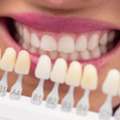 Dental Veneers Treatment In Kondapur