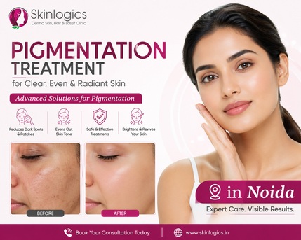 Noida, Health, Laser Pigmentation Treatment In Noida &ndash; Safe & Effective