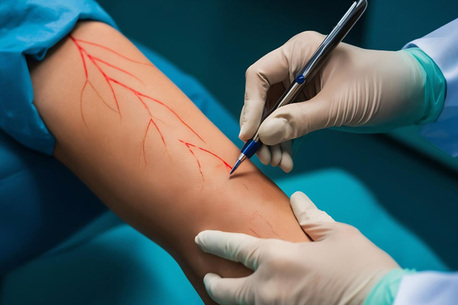 Madurai, Health, Vascular Surgery In Madurai