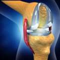 Joint Replacement Surgery East Delhi