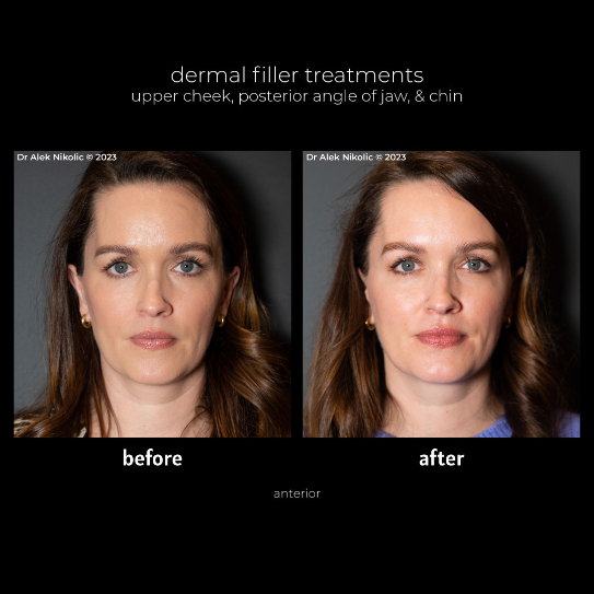 Cape Town, Beautician, Dermal Fillers For Refined Contours And Lasting Beauty