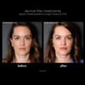 Dermal Fillers For Refined Contours And Lasting Beauty