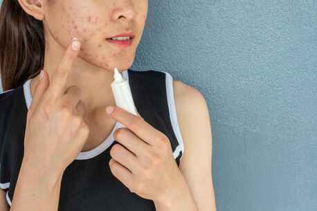 Noida, Health, Acne Treatment In Noida &ndash; Say Goodbye To Pimples And Breakouts