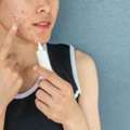 Acne Treatment In Noida &ndash; Say Goodbye To Pimples And Breakouts