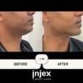 Double Chin Fat Dissolving Cost Toronto | Injex Beauty