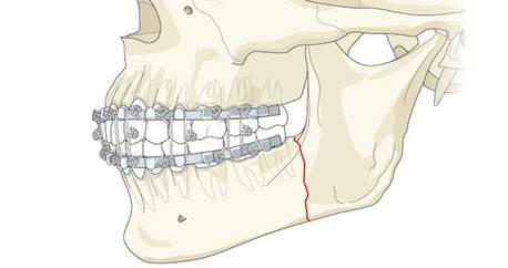 Indore, Health, Jaw Surgery In India | Dr. Anurag Bhargava