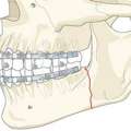 Jaw Surgery In India | Dr. Anurag Bhargava