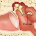 Stapedotomy Surgery In Dubai