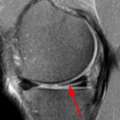 Where Can I Get An MRI Of The Knee Joint Quickly?