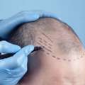 Trusted Hair Transplant Surgeon In Bangalore!