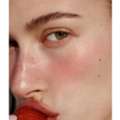 Rosacea Laser Treatment Toronto | Tight Clinic | Book Today