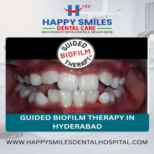 Hyderabad, Dental, Affordable Guided Biofilm Therapy Cost In Hyderabad | Advanced Dental Cleaning Solutions