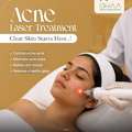 Acne Laser Treatment In Chandanagar