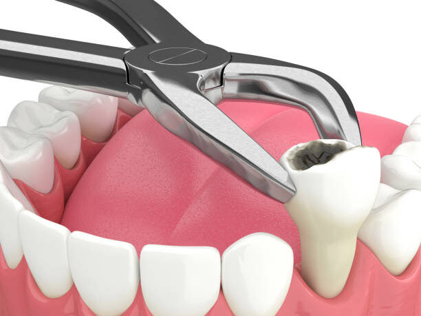 Pune, Dental, Wisdom Tooth Extraction In Pune | Safe & Painless Tooth Removal