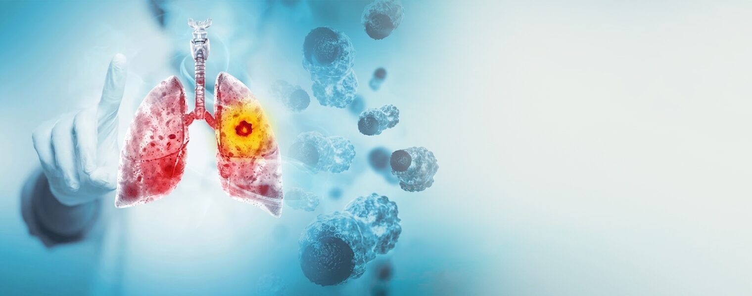 New Delhi, Health, Lung Cancer Treatment In Lajpat Nagar