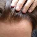 Affordable Custom Hair Replacement Systems With Natural Results