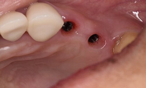 Mexico City, Dental, All-on-4 Dental Implants In Tijuana, Mexico &ndash; Affordable, Life-Changing Results!