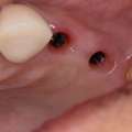 All-on-4 Dental Implants In Tijuana, Mexico &ndash; Affordable, Life-Changing Results!