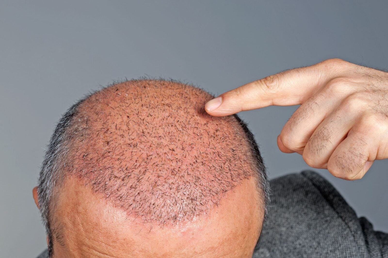 Gurgaon, Health, Best Hair Transplant Clinic In Gurgaon For Natural Results