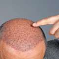 Best Hair Transplant Clinic In Gurgaon For Natural Results
