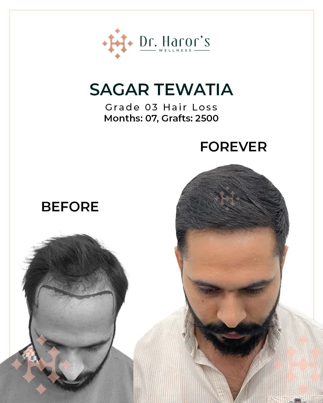 New Delhi, Health, Frame Your Face Perfectly &mdash; Restore Your Temples!