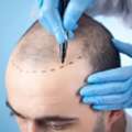 Get Natural And Permanent Hair Without Breaking Your Bank