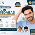 Get Hair Transplant In Gujarat In Ahmedabad