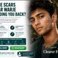 Acne Scar Treatment Near Warje | Campus Ready Skin Before Your Next Semester